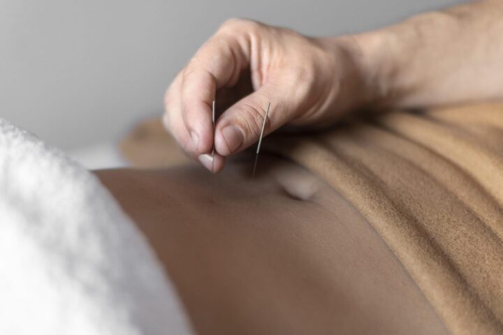 Akupunktura na kregosłup to skuteczna metoda leczenia.