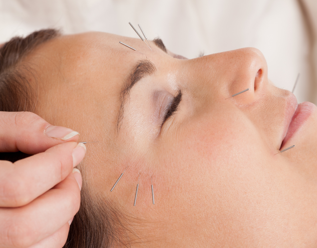 akupunktura twarzy MTS Holistic Therapy